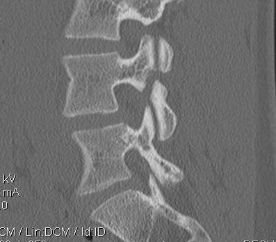 L4 Pars Defect